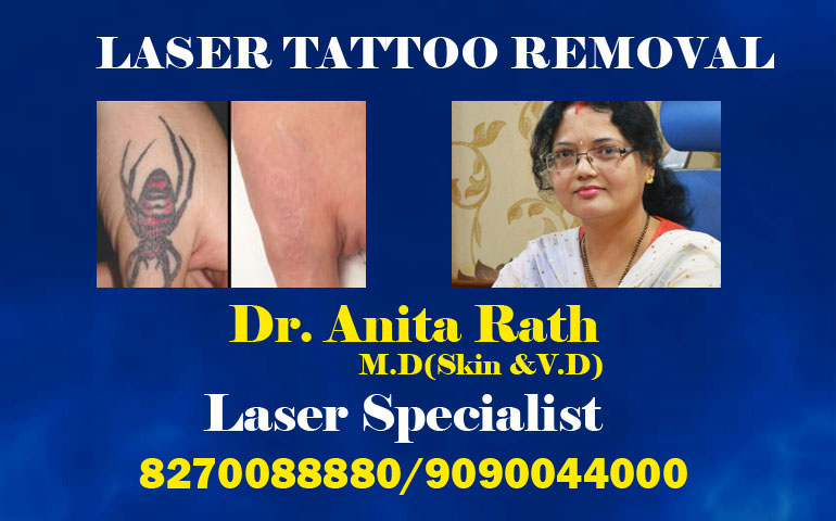 Laser Tattoo Removal in Kolkata  Lizards Skin Tattoo Parlour