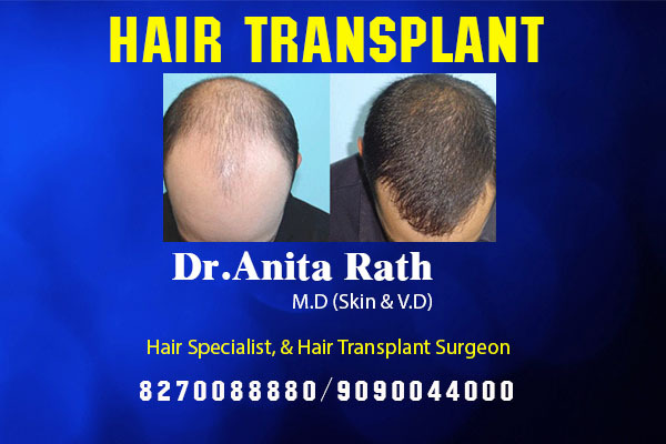 Best Hair Transplant For Women, Bhubaneshwar