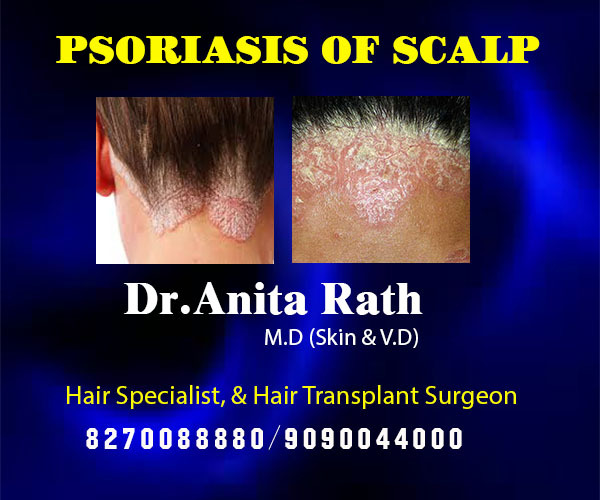 solve hair loss problem in best hair transplant clinic in bhubaneswar