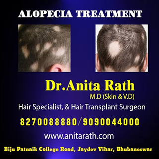 alopecia treatment