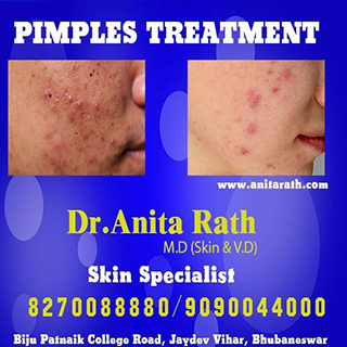 pimples clinic